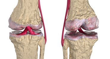 Osteoartrit (Eklemlerde Kireçlenme)