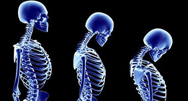 Osteoporoz